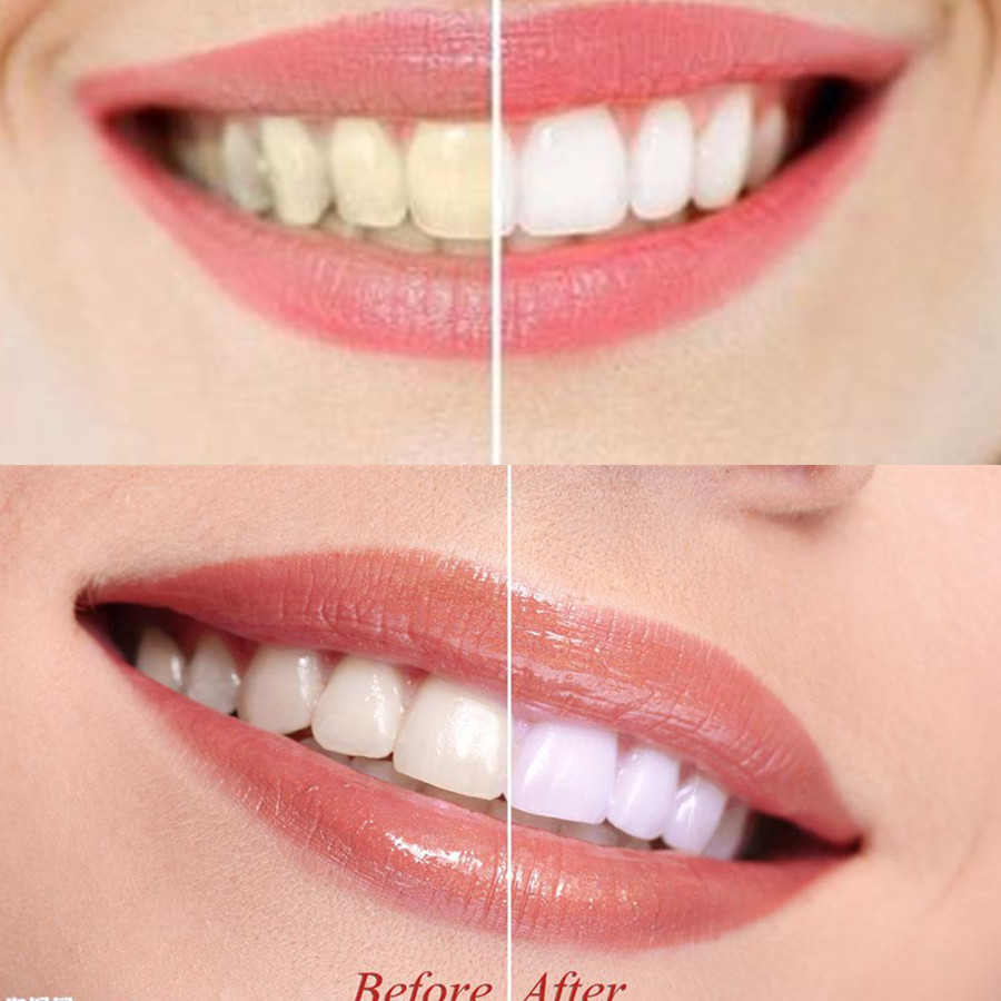 Dientes de carbón de bambú par - Teeth Whitening Kit reseña y precio
