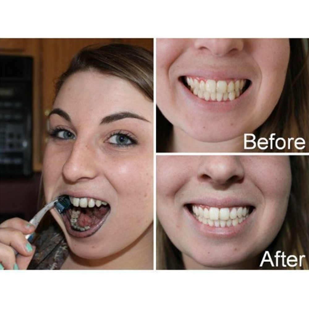 Dientes de carbón de bambú par - Teeth Whitening Kit reseña y precio