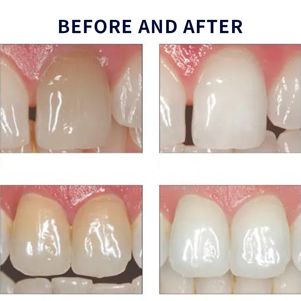 Opalescencia blanqueadora 20%  - Teeth Whitening Kit reseña y precio