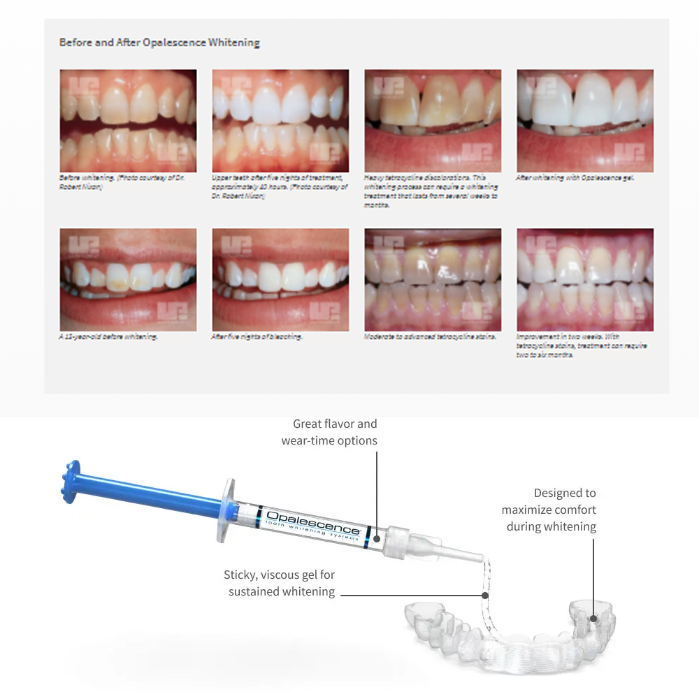 Opalescencia blanqueadora 20%  - Teeth Whitening Kit reseña y precio